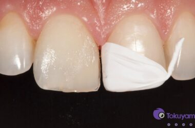 Tokuyama-Palfique-Omnichroma-I-Case-5-Class-IV-Fracture-Tooth-With-Putty-Matrix